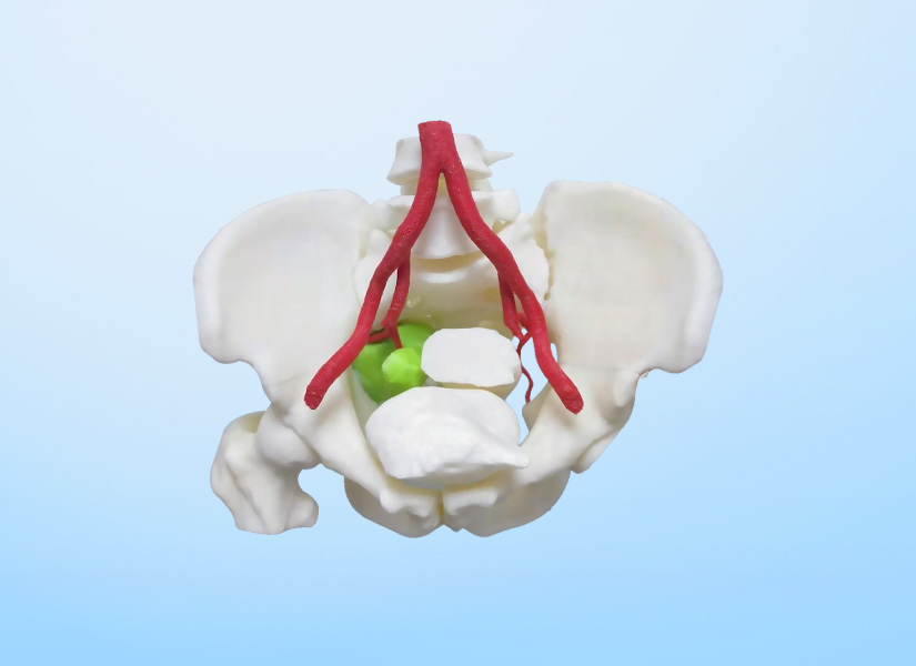 3D打印手术模型利用
